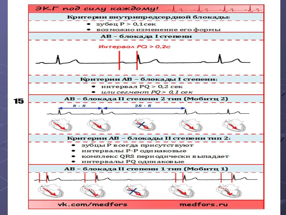 Аритмии и блокады сердца презентация
