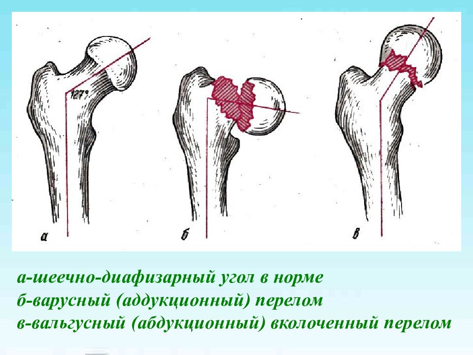 Переломы проксимального отдела бедренной кости презентация