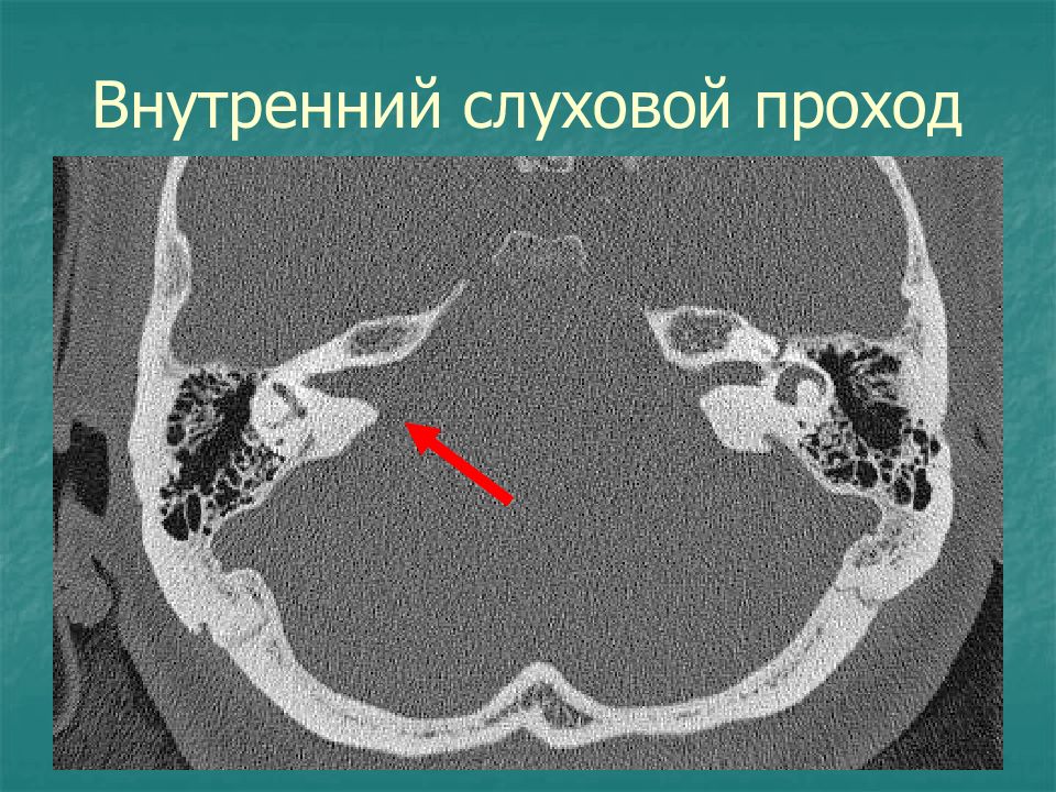 Кт височных костей. Кт височных костей Ульяновск.