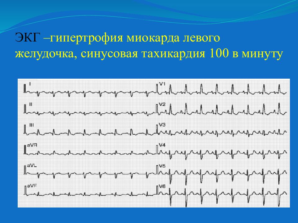 Синусовый ритм у взрослого. Ритм синусовый с ЧСС 90 ЭКГ. ЭКГ тахикардия синусовый ритм. Тахикардии ритмы на ЭКГ. ЭКГ гипертрофия миокарда левого желудочка ЧСС.