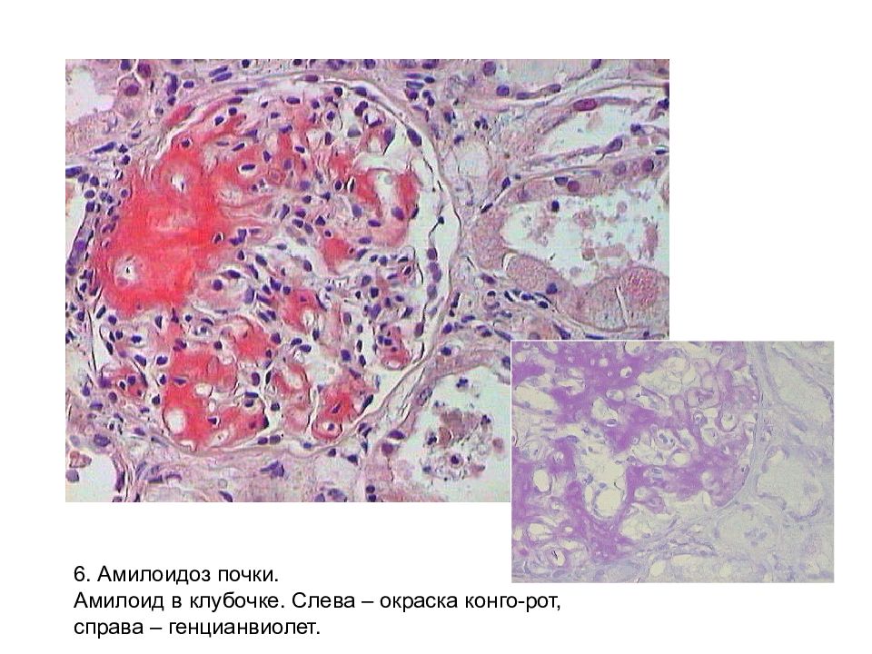 Амилоидоз почек картинки