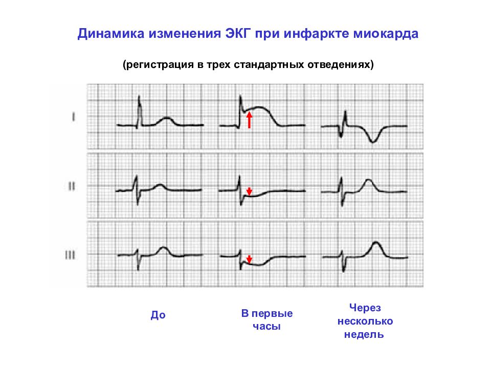 Рисунок кардиограммы сердца при инфаркте миокарда