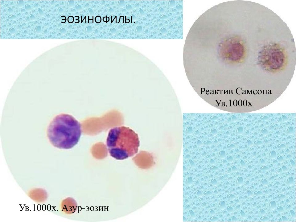 реактив самсона для окраски ликвора. реактив самсона для окраски ликвора. ликвор микроскопия реактив самсона. кристаллы холестерина в мокроте. набор реагентов (диахим-общий белок).