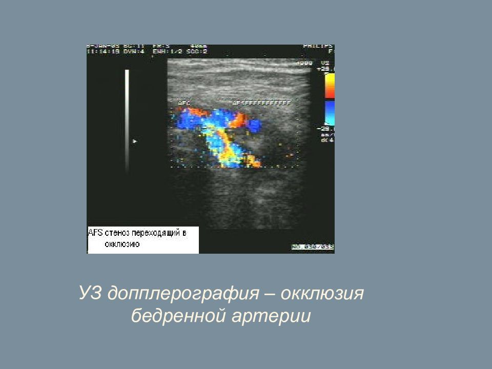 Окклюзия подколенной артерии. Ультразвуковая допплерография бедренной артерии. УЗИ артерий конечностей окклюзия протокол. Окклюзия бедренной артерии на УЗИ. Окклюзия УЗДГ нижних конечностей.