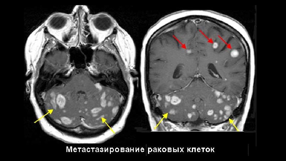 Доброкачественная опухоль головного мозга сколько живут. Вторичные Метастатические опухоли головного мозга. Опухоль головного мозга метастазы. Томограмма опухоли головного мозга. Метастазы головного мозга мрт.