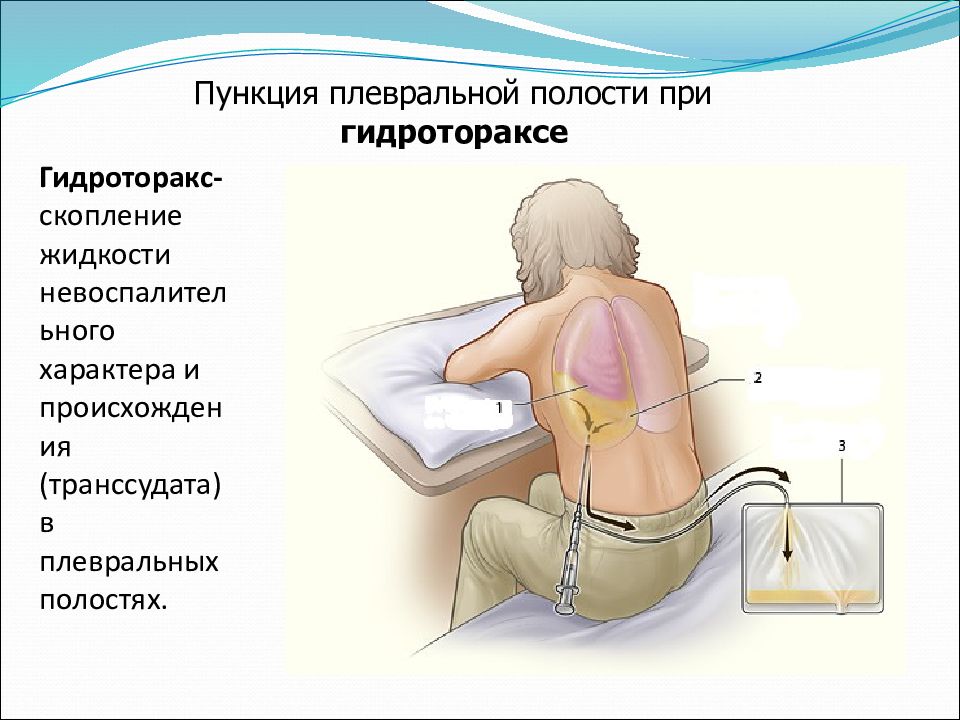 Как выкачивают жидкость из легких