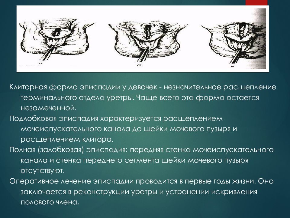 Гипоспадия что это. Экстрофия мочевого пузыря, эписпадия. Эписпадия уретры у мальчиков. Эписпадия у девочек операция.