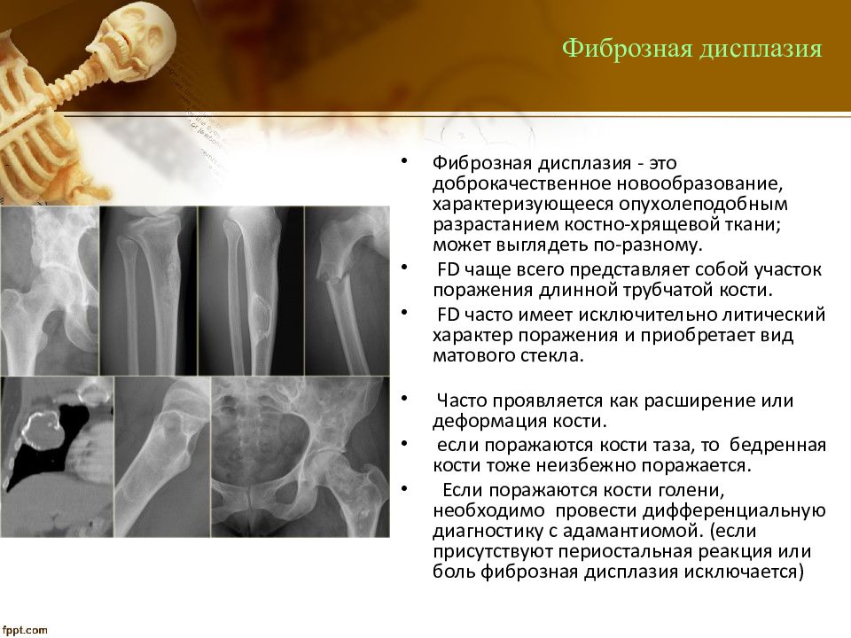 Фиброзная дисплазия большеберцовой кости у детей фото