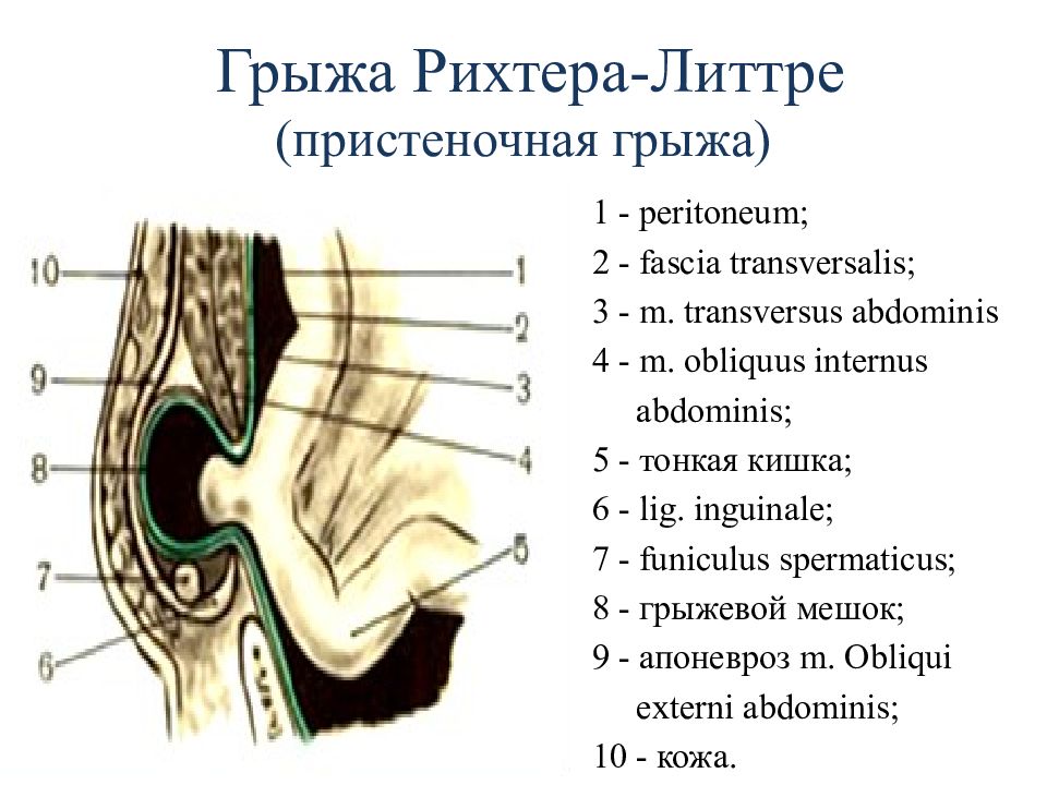 Ущемленная грыжа передней брюшной стенки карта вызова