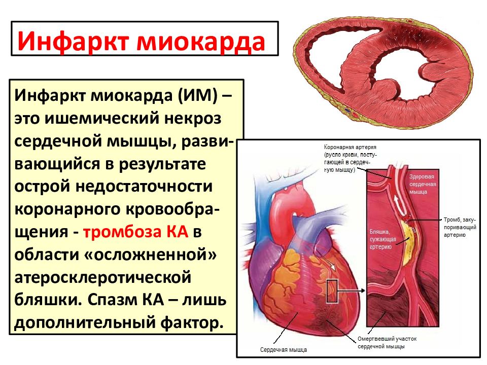 Инфаркт миокарда на картинке