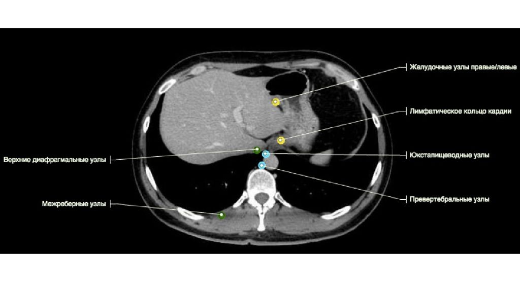 Кт клетки. Диафрагмальные лимфатические узлы кт. Подключичные лимфатические узлы на кт. Лимфатические узлы грудной клетки кт. Ретрокруральные лимфоузлы кт.