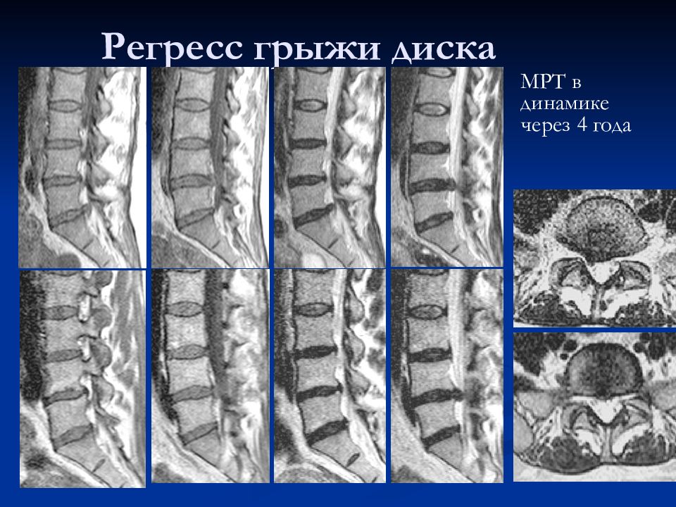 Диск для мрт. Грыжа и протрузия на мрт. Грыжи межпозвоночных дисков мрт. Грыжа межпозвоночного диска мрт.