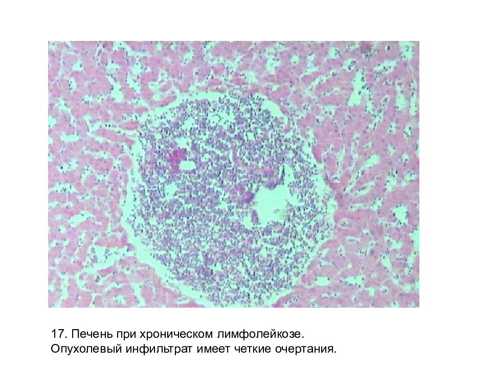 Селезенка при лейкозе. Хронический лимфолейкоз микропрепарат селезенки. Хронический лимфолейкоз печени микропрепарат. Печень при хроническом лимфолейкозе микропрепарат рисунок. Хронический лимфолейкоз микропрепарат.