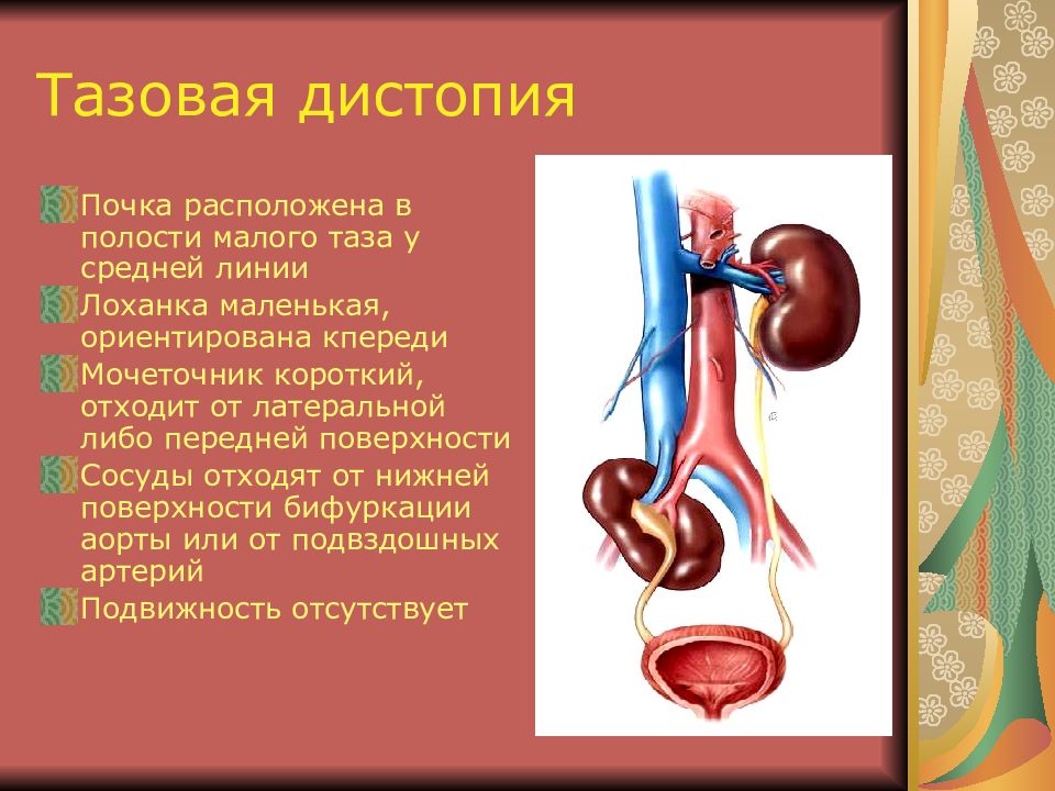 Дистопия почки. Аномалии расположения почек. Тазовое расположение почки.