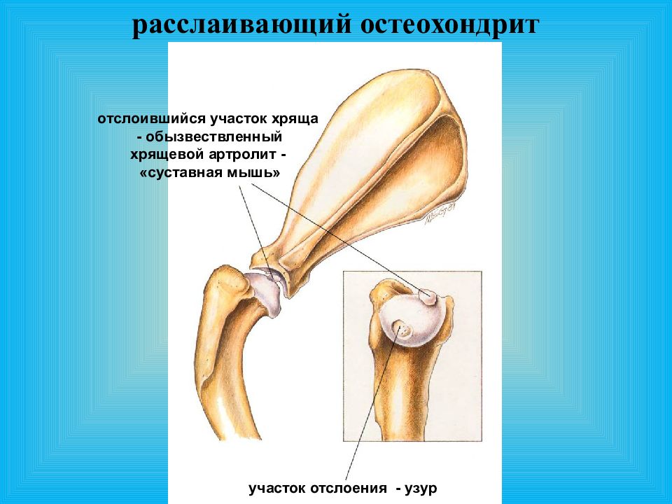 Соединение костей 6. Расслаивающий остеохондрит. Синдесмология, соединение костей. Рассекающий остеохондрит коленного сустава.