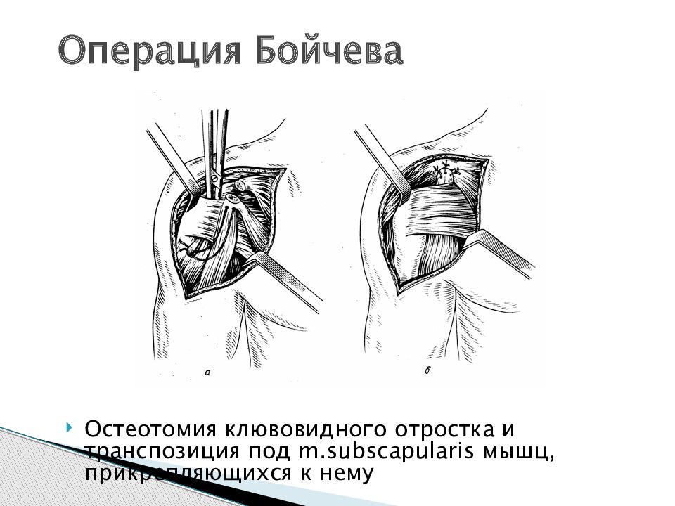 Привычный вывих плечевого сустава