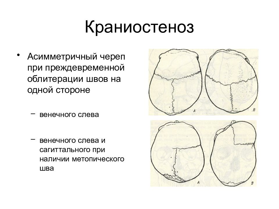 Определить ранний. Краниостеноз сагиттального шва. Крайнеосинтоз метопического шва. Краниостеноз стреловидного шва. Краниосиностоз метопического шва.