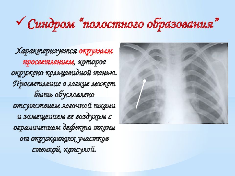 Просветление в легких. Участок просветления легочной ткани. Просветление легких. Полостное образование легкого кт. Синдром просветления легочной ткани.
