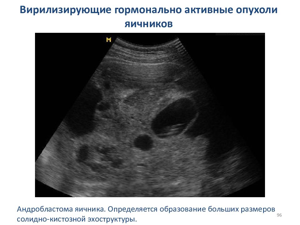 Феминизирующие опухоли яичников презентация