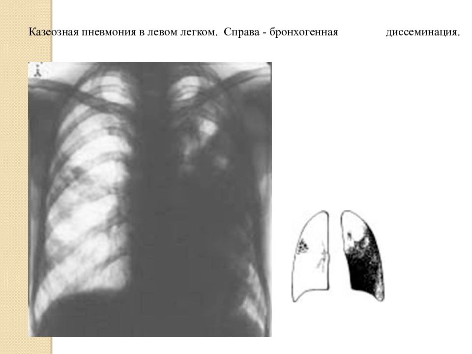 Казеозная пневмония презентация