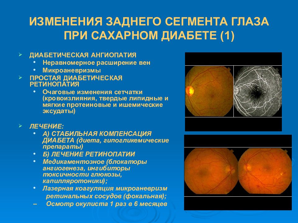 Изменение органов. Изменение органа зрения при сахарном диабете. Поражение органа зрения при сахарном диабете. Микроаневризмы сетчатки. Изменения глаза при сахарном диабете.