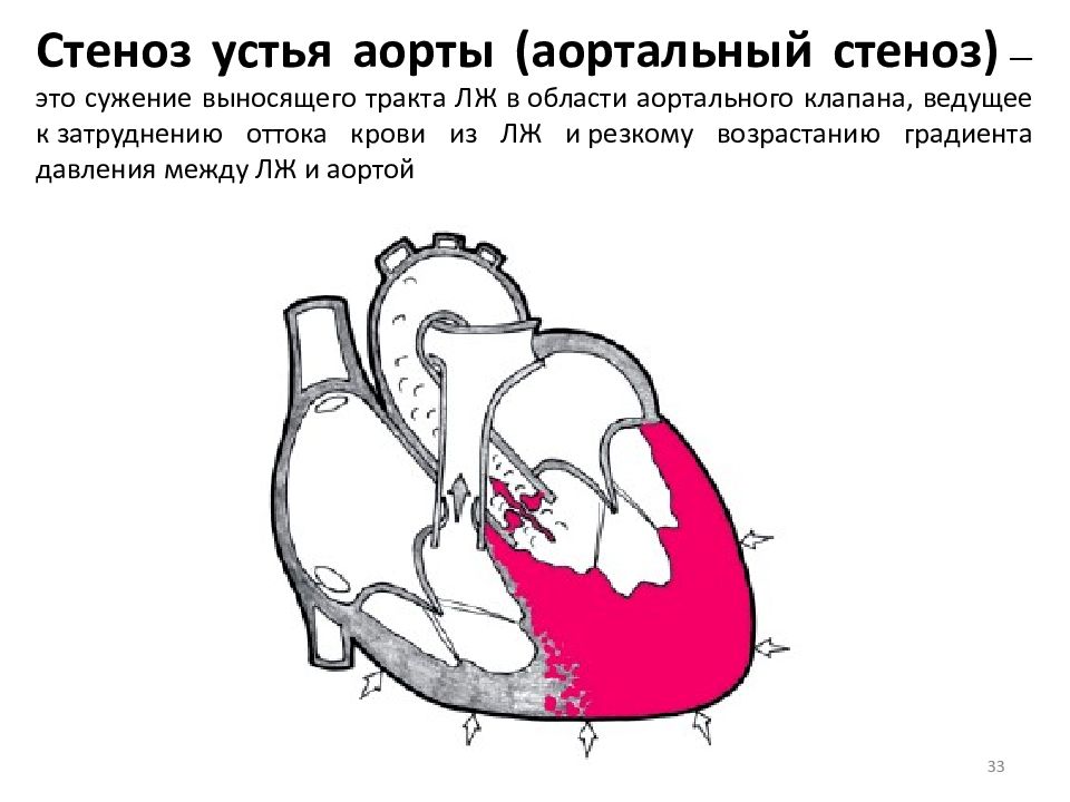 Стеноз устья аорты гемодинамика схема