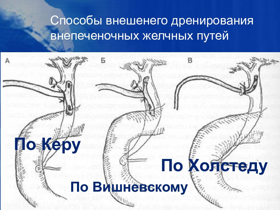 Операции на внепеченочных желчных протоках. Дренаж культи пузырного протока по Холстеду-Пиковскому. Виды внутреннего дренирования общего желчного протока. Дренирование холедоха по Пиковскому. Способы дренирования общего желчного протока.