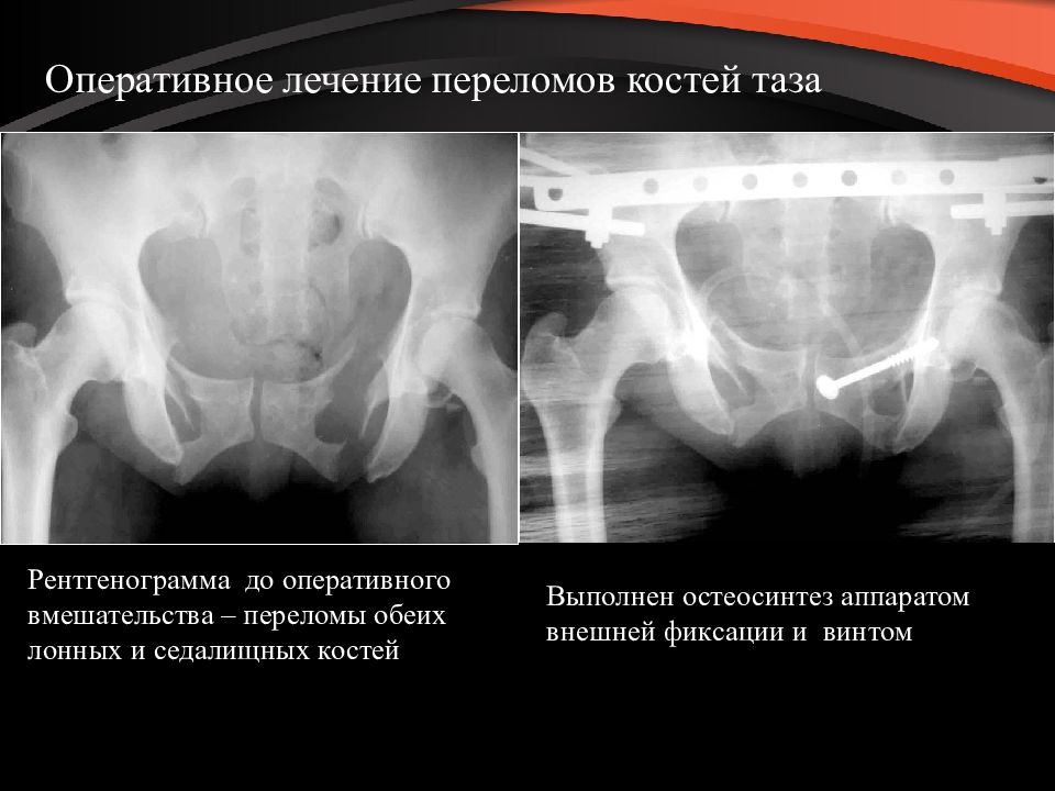 Презентация на тему перелом костей таза