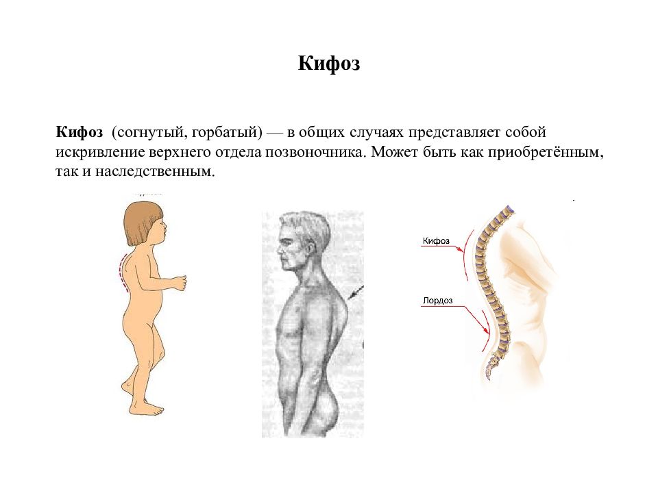 Кифоз. Кифоз верхнего отдела позвоночника. Выраженный кифоз грудного отдела позвоночника. Врожденный кифоз позвоночника.