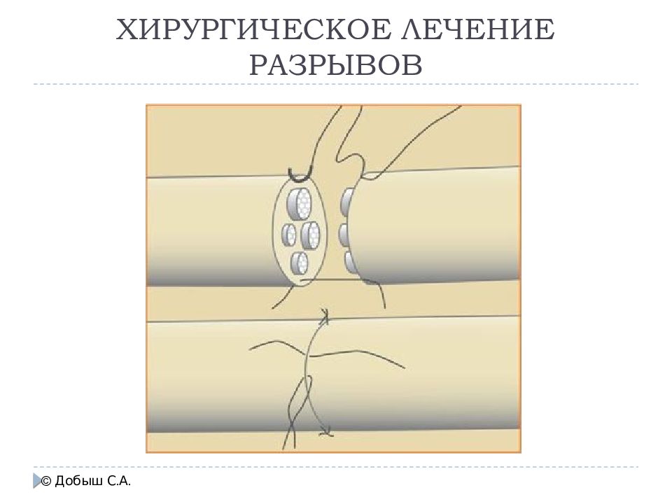 Разрыв шаблонов в медицине. Хирургическое лечение ИБП. Хирургическое лечение макростомии.