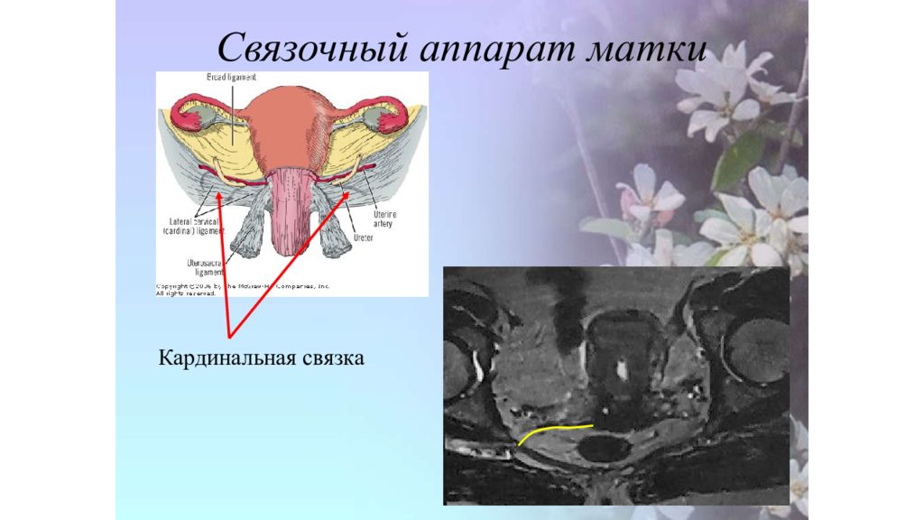 Связка подвешивающая яичник. Связочный аппарат яичника. Связочный аппарат матки анатомия. Фиксирующий аппарат матки анатомия. Кардинальные связки матки анатомия.
