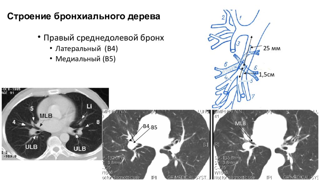 Кт бронхов. Анатомия бронхиального дерева на кт. Анатомия бронхов на кт. Бронхи легких кт. Сегментарные бронхи на кт.