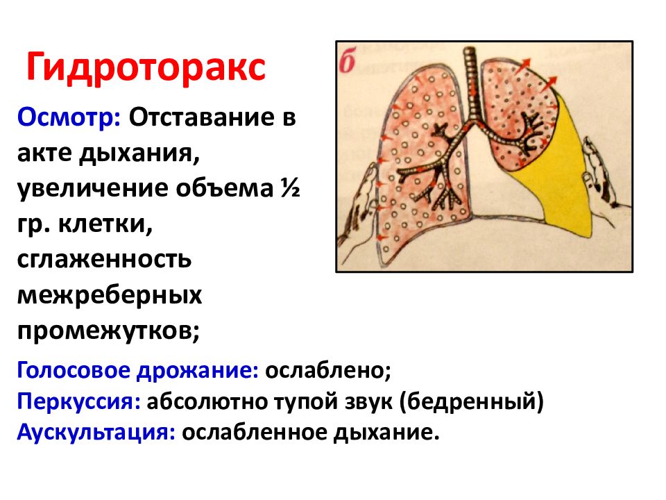 Гидроторакс операция. Аускультация при гидротораксе легких.