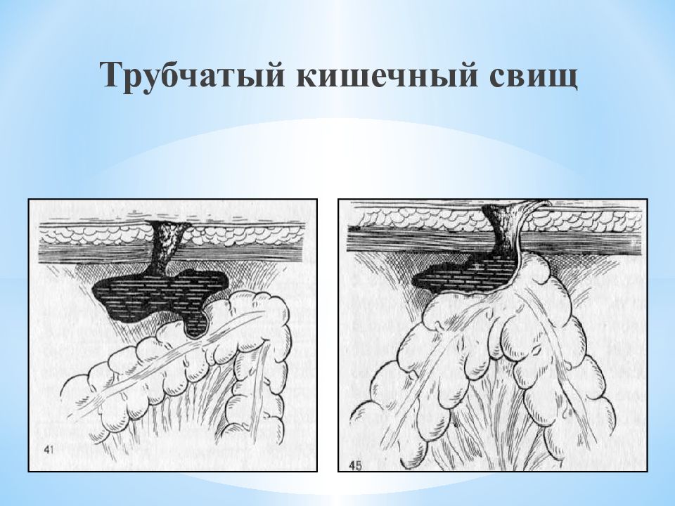 Кишечный свищ. Несформированный кишечный свищ. Губовидный кишечный свищ. Кишечные свищи трубчатый и губовидный. Трубчатый кишечный свищ.