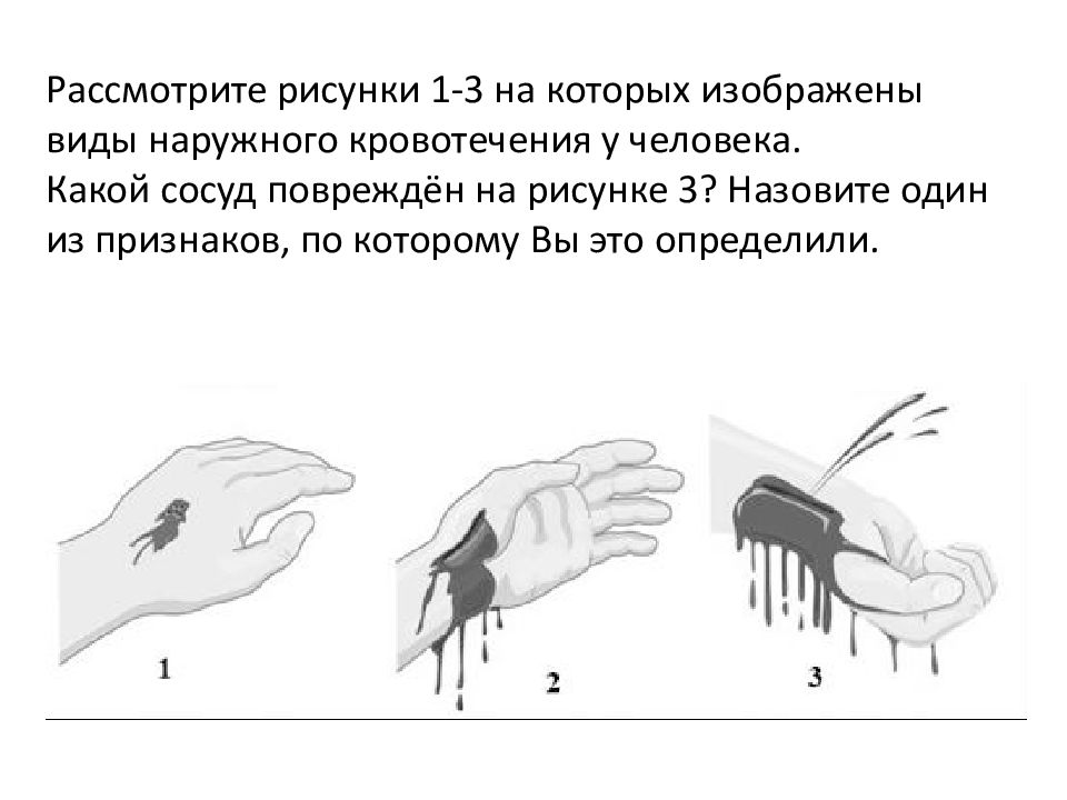 Рассмотрите рисунок с изображением повреждений кровеносных сосудов какой сосуд поврежден на нижнем