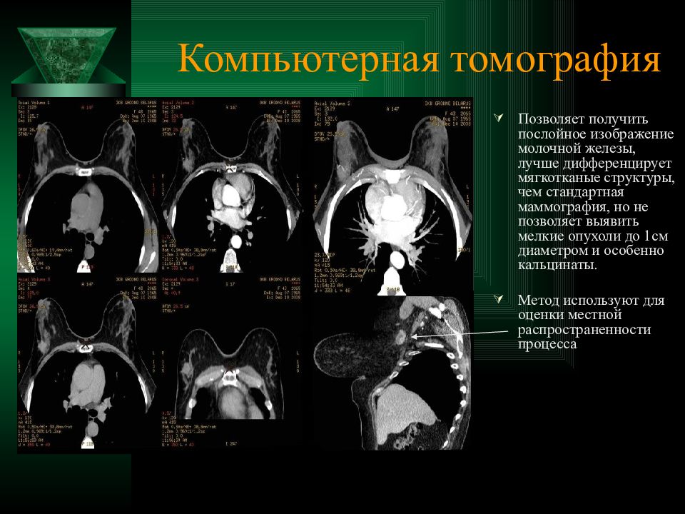 На кт виден рак. Опухоль молочной железы на кт. Магнитно-резонансная томография молочных желёз. Компьютерная томография (кт). Молочной железы.