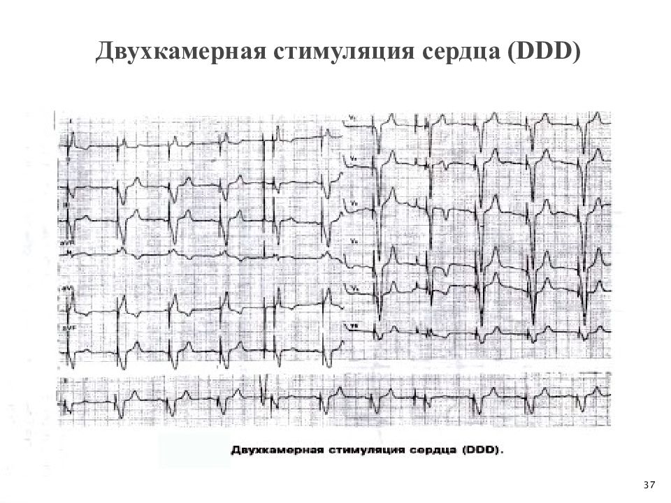 Нарушения проводимости презентация