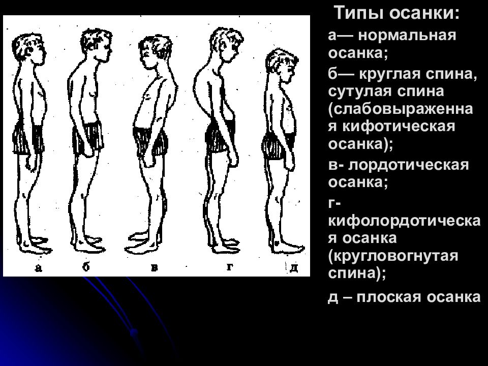 Типы осанки. Типы осанки нормальная сутулая. Кифотический Тип осанки. Лордотический Тип осанки. Тип осанки круглая спина.