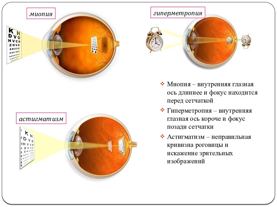 Миопия астигматизм глаз. Эмметропия миопия гиперметропия. Миопия гиперметропия астигматизм пресбиопия. Миопия фокус перед сетчаткой. Близорукость 1 степени.
