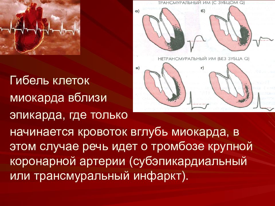 Трансмуральный инфаркт. Трансмуральный инфаркт миокарда. Трансмуральный и нетрансмуральный инфаркт миокарда. Острый трансмуральный инфаркт миокарда. Трансмуральное повреждение миокарда.