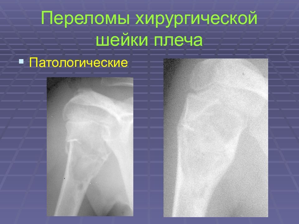 Перелом хирургической шейки плеча