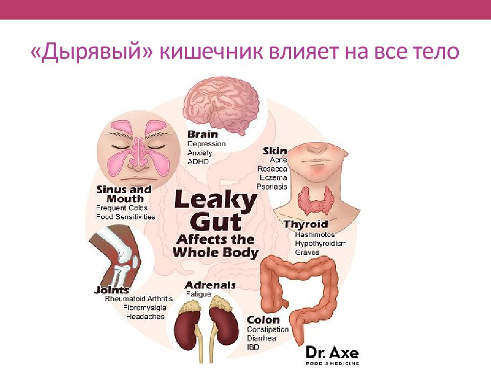 Влияние кишечника. Дырявый кишечник симптомы. Синдром дырявой кишки симптомы. Негерметичный кишечник.