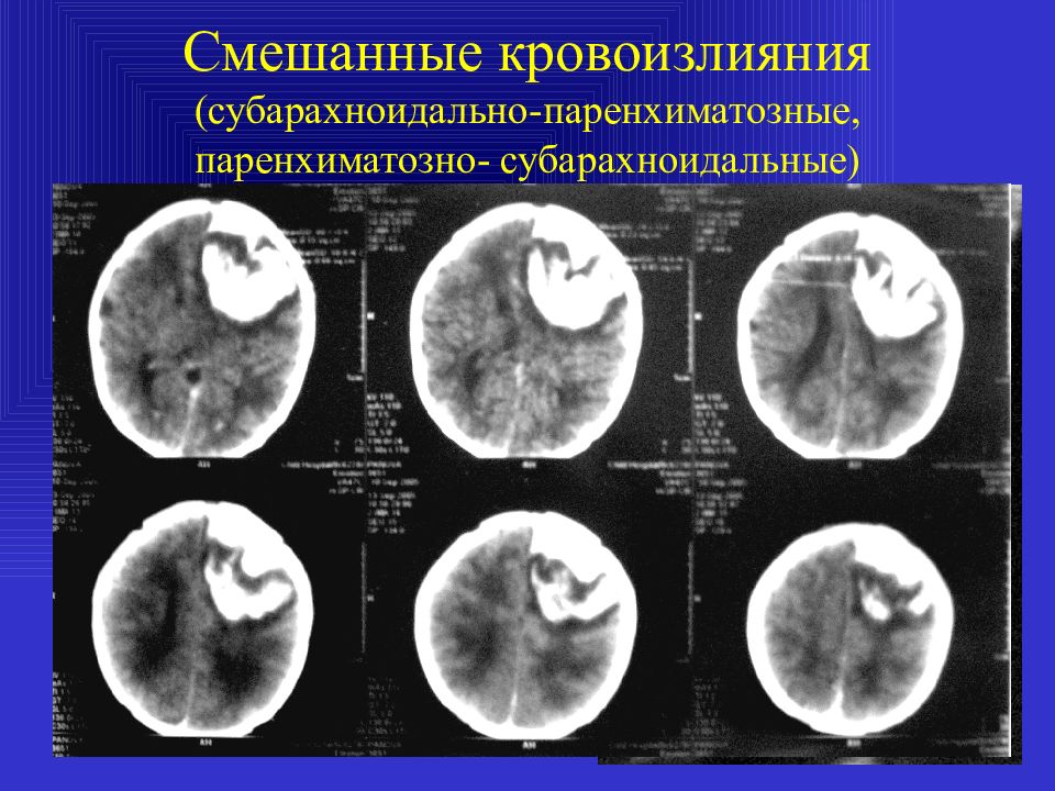 Степени кровоизлияния. Паренхиматозно-субарахноидальное кровоизлияние кт. Паренхиматозное кровоизлияние головного мозга кт. Геморрагический инсульт паренхиматозное кровоизлияние. Субарахноидальное вентрикулярное кровоизлияние.