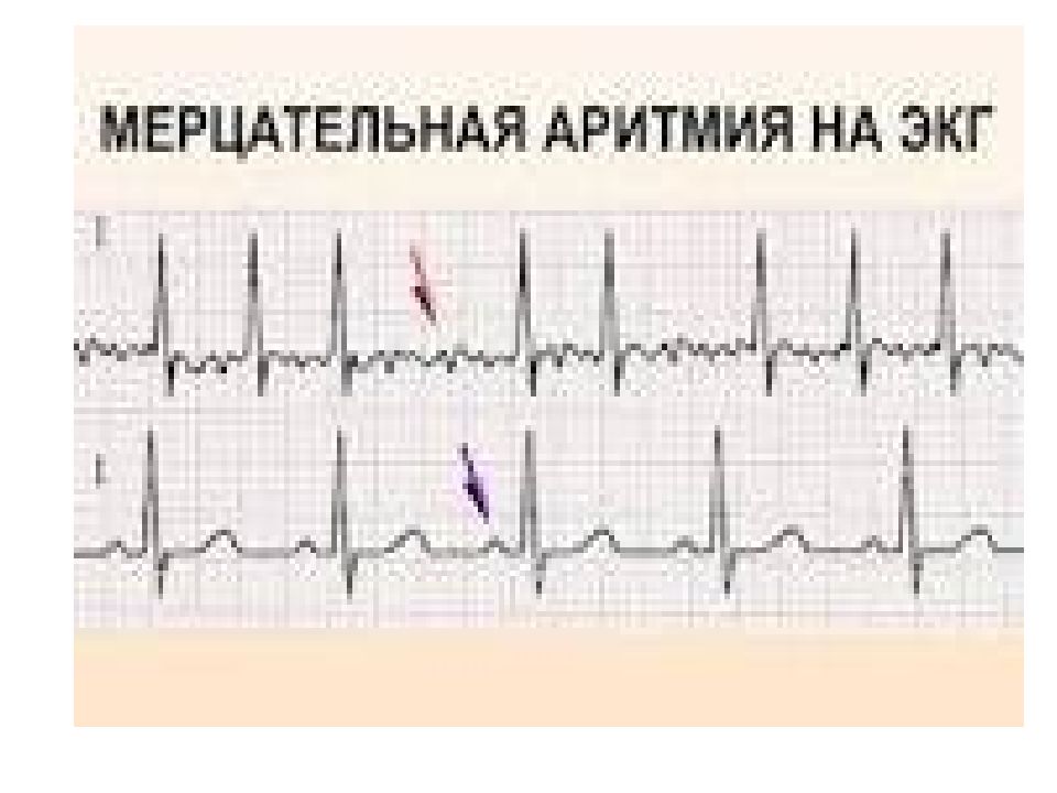 Мерцательная аритмия экг картинки