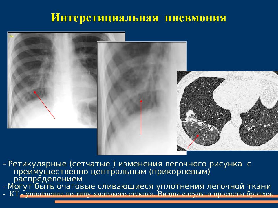Что означает фиброзное изменение. Рентген при интерстициальной пневмонии. Интерстициальная пневмония кт2. Интерстициальная пневмония рентген. Фиброз легочной ткани кт.