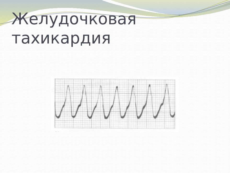 Желудочковая тахикардия картинки