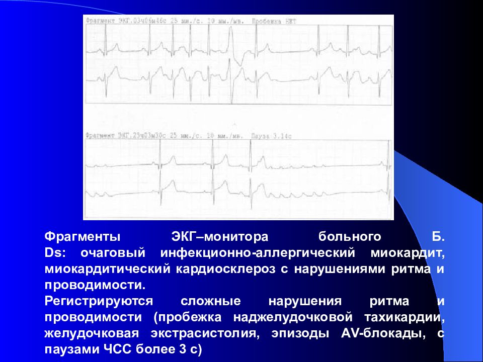 Нарушения на экг. Наджелудочковые нарушения ритма ЭКГ. ЭКГ при сложных нарушениях ритма и проводимости. Миокардит желудочковая экстрасистолия ЭКГ. Нарушение проводимости миокарда.