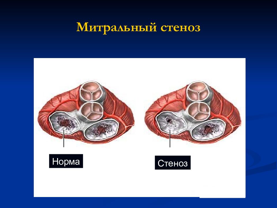 Митральный стеноз картинка