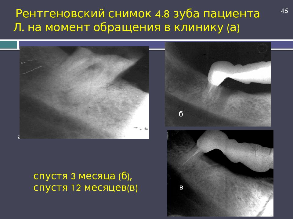 Рентгеновский снимок 4.8 зуба пациента Л. на момент обращения в клинику (а)