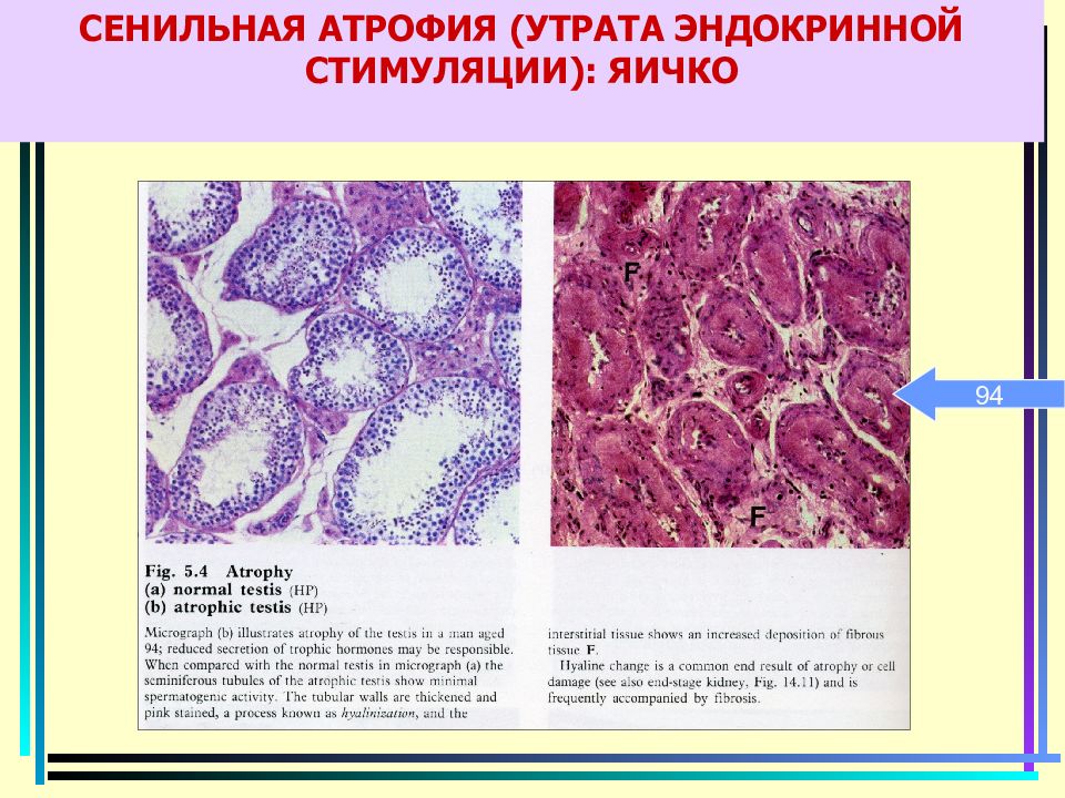 Дегенерация 3 степени